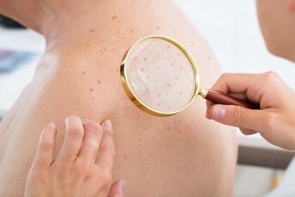 Oxidative stress is considered to be a contributing factor in several skin diseases, including atopic dermatitis, psoriasis and skin cancer. (Shutterstock) Oxidative stress is considered to be a contributing factor in several skin diseases, including atopic dermatitis, psoriasis and skin cancer. (Shutterstock)