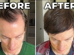 Bryan Johnson restored natural hair colour and reversed hair fall.