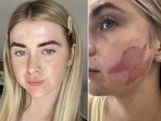 Melia Nielsen was left with second-degree burns after undergoing a popular cosmetics procedure that went awry