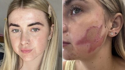 Melia Nielsen was left with second-degree burns after undergoing a popular cosmetics procedure that went awry Melia Nielsen was left with second-degree burns after undergoing a popular cosmetics procedure that went awry