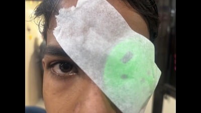 A young patient at PGIMER’s Advanced Eye Centre receives treatment for a firecracker-related eye injury. (HT photo) A young patient at PGIMER’s Advanced Eye Centre receives treatment for a firecracker-related eye injury. (HT photo)