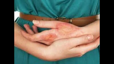 Senior medical officer Dr Harpreet Singh said the local civil hospital treated a solitary minor burn case on Friday night. He added that the patient was discharged after primary care. (HT File)