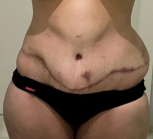 Instead of lifting the excess skin, the surgery ended up misaligning her body altogether. (Instagram/@sleeved.and.relieved)