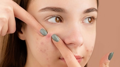 Air pollution can trigger conditions such as acne, psoriasis, atopic dermatitis. (Pexels) Air pollution can trigger conditions such as acne, psoriasis, atopic dermatitis. (Pexels)