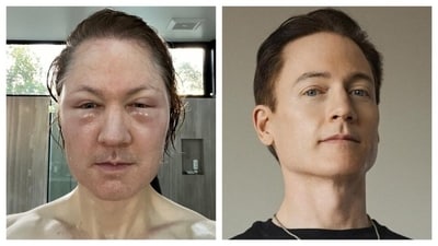 Bryan Johnson looks unrecognisable after a recent anti-aging procedure. (Instagram/ Bryan Johnson) Bryan Johnson looks unrecognisable after a recent anti-aging procedure. (Instagram/ Bryan Johnson)
