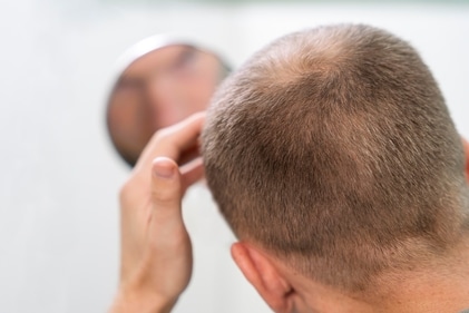 Telogen Effluvium is a temporary hair loss condition (Freepik) Telogen Effluvium is a temporary hair loss condition (Freepik)