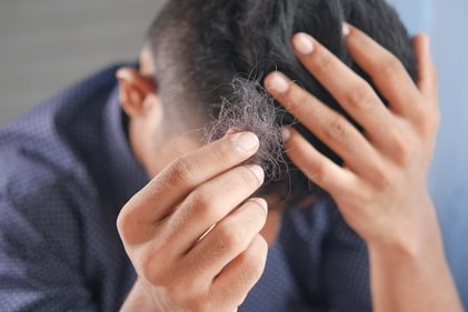 Androgenetic alopecia, commonly known as male or female pattern baldness, is a hereditary condition. (Pixabay) Androgenetic alopecia, commonly known as male or female pattern baldness, is a hereditary condition. (Pixabay)
