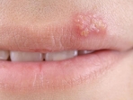 Cold sores: Why sharing a kiss could spread more than love 
