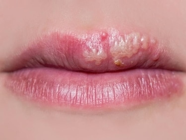 More than 3.7 billion people under the age of 50 suffer from the herpes simplex virus type 1, HSV-1. (Shutterstock)