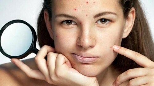Do not squeeze your pimples. This usually leads to further inflammation, which makes the acne look worse and last longer. (Shutterstock) Do not squeeze your pimples. This usually leads to further inflammation, which makes the acne look worse and last longer. (Shutterstock)