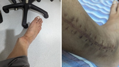 Ratnendu Ray shared a picture of his swollen leg which showed a visibly dislocated bone for which he required surgery. (X/@ratnenduray) Ratnendu Ray shared a picture of his swollen leg which showed a visibly dislocated bone for which he required surgery. (X/@ratnenduray)