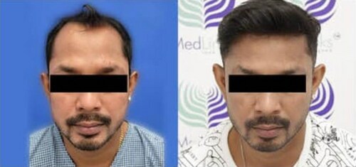 Hair transplant surgery is a safe and effective way to restore your hair and your confidence. Hair transplant surgery is a safe and effective way to restore your hair and your confidence.