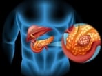 Are you at risk? Top 5 factors that could lead to pancreatic cancer.