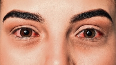 There is no treatment or vaccine for the Margburg virus aka the bleeding eye virus (adobe stock) There is no treatment or vaccine for the Margburg virus aka the bleeding eye virus (adobe stock)