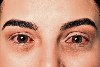 Margburg virus is also called bleeding eyes virus (adobe stock) Margburg virus is also called bleeding eyes virus (adobe stock)