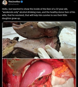 A post comparing two livers, shared by The Liver Doctor. (X/@theliverdr) A post comparing two livers, shared by The Liver Doctor. (X/@theliverdr)