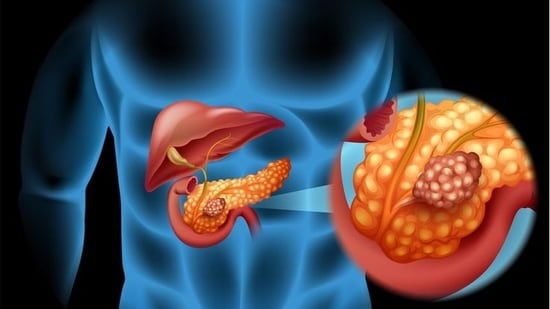 Are you at risk? Top 5 factors that could lead to pancreatic cancer. (File Photo)