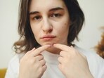 Popping pimples leads to nasty spots. Here's how to fix it. Popping pimples leads to nasty spots. Here's how to fix it.