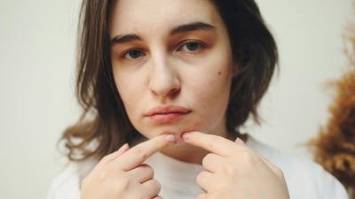 Popping pimples leads to nasty spots. Here's how to fix it. Popping pimples leads to nasty spots. Here's how to fix it.