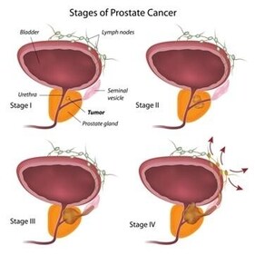 Stages of prostate cancer in men. (File Photo) Stages of prostate cancer in men. (File Photo)