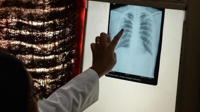 A doctor checks the chest X-ray of a patient in the tuberculosis (TB) department of the government-run Osmania General Hospital in Hyderabad on October 30, 2019. (Photo by NOAH SEELAM / AFP) (AFP) A doctor checks the chest X-ray of a patient in the tuberculosis (TB) department of the government-run Osmania General Hospital in Hyderabad on October 30, 2019. (Photo by NOAH SEELAM / AFP) (AFP)