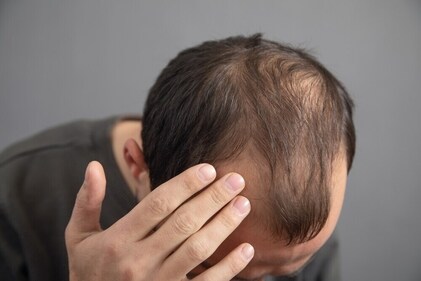 There are chances of slow hair growth. (Shutterstock) There are chances of slow hair growth. (Shutterstock)