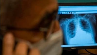 At present, there is no such cure for idiopathic pulmonary fibrosis. (Reuters) At present, there is no such cure for idiopathic pulmonary fibrosis. (Reuters)
