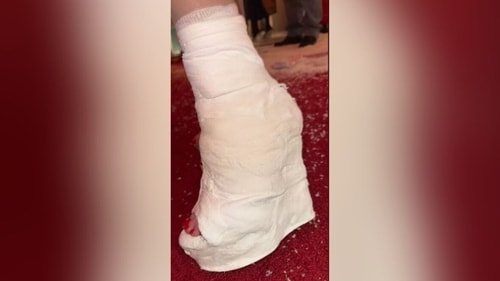 Kim Kardashian shares new photo of her foot cast to her Instagram Stories. (Instagram)