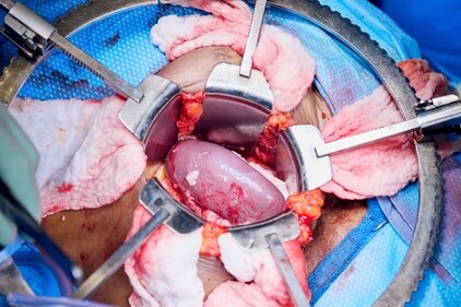 The gene-edited pig kidney moments after blood vessels are reattached and the organ is reperfused with Towana Looney’s blood. (AP)