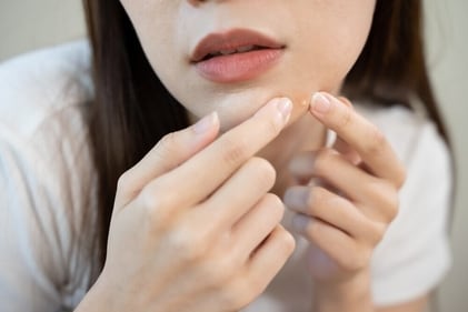 Popping a pimple may leave behind scars and hyperpigmentation. (Shutterstock) Popping a pimple may leave behind scars and hyperpigmentation. (Shutterstock)