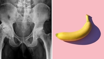 After discovering that his penis is “turning into bone,” the man declined further examination and treatment. (Urology Case Reports/Unsplash/dorner) After discovering that his penis is “turning into bone,” the man declined further examination and treatment. (Urology Case Reports/Unsplash/dorner)