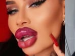 Fetisch Barbie has Botox in her “whole face” along with filler injected in her cheeks, chin, nose and lips too.