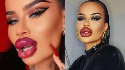 Fetisch Barbie has Botox in her “whole face” along with filler injected in her cheeks, chin, nose and lips too. (YouTube/@FetischBarbie) Fetisch Barbie has Botox in her “whole face” along with filler injected in her cheeks, chin, nose and lips too. (YouTube/@FetischBarbie)