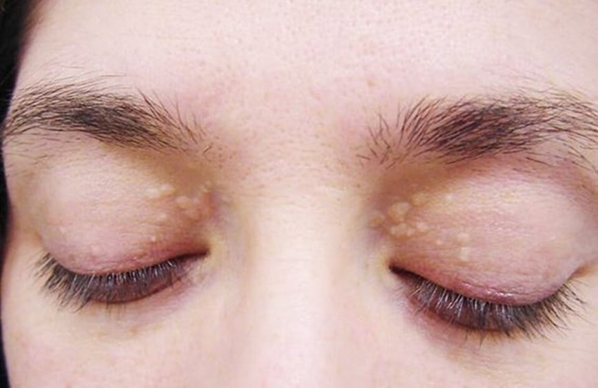 Blurry vision, grey, white and yellow deposits around the cornea, yellow bumps around your eyes can all indicate worrying levels of high cholesterol. (Pinterest) Blurry vision, grey, white and yellow deposits around the cornea, yellow bumps around your eyes can all indicate worrying levels of high cholesterol. (Pinterest)