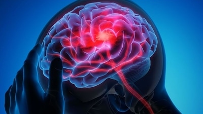 Preventing winter stroke: Tips to stay safe this cold season and keep brain attack at bay. (Photo by Yashoda Hospitals) Preventing winter stroke: Tips to stay safe this cold season and keep brain attack at bay. (Photo by Yashoda Hospitals)