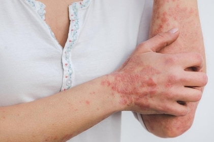Skin diseases like psoriasis, vitligo, eczema or acne can be related to a damaged gut. (Pixabay) Skin diseases like psoriasis, vitligo, eczema or acne can be related to a damaged gut. (Pixabay)