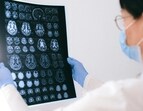 The researchers studied brain tissue samples from multiple regions, including hippocampus and entorhinal cortex, the areas typically most affected by Alzheimer’s disease. The researchers studied brain tissue samples from multiple regions, including hippocampus and entorhinal cortex, the areas typically most affected by Alzheimer’s disease.