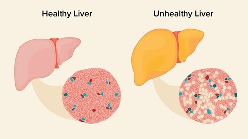 Diet, lifestyle modifications to treat fatty liver (Photo by Twitter/144Health) Diet, lifestyle modifications to treat fatty liver (Photo by Twitter/144Health)