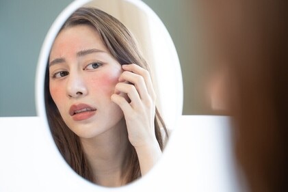 Irritated skin is one of the sign retinol is not working for you. (Shutterstock ) Irritated skin is one of the sign retinol is not working for you. (Shutterstock )