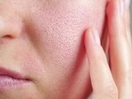 Enlarged pores are a common skin condition, when the pores become more visible due to excess oil production and other reasons. Enlarged pores are a common skin condition, when the pores become more visible due to excess oil production and other reasons.