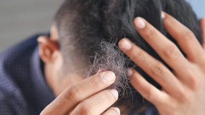 Villagers have experienced sudden and severe hair loss leading to baldness within days. Representative Image (Pixabay) Villagers have experienced sudden and severe hair loss leading to baldness within days. Representative Image (Pixabay)