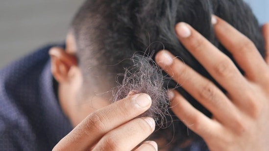 Villagers have experienced sudden and severe hair loss leading to baldness within days. Representative Image (Pixabay)