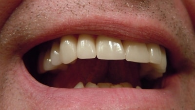 Symptoms of jaw metastases can be subtle and often be confused for common dental problems. (Representational) Symptoms of jaw metastases can be subtle and often be confused for common dental problems. (Representational)