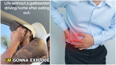 One of the most common symptoms of gallbladder removal is diarrhoea.