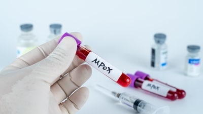 This is said to be the first Mpox case of Karnataka in 2025 and the patient is being closely monitored. (Shutterstock)
