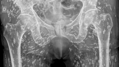 A US doctor described the scan as one of the “most insane X-rays” he has ever encountered. (X/@EM_RESUS) A US doctor described the scan as one of the “most insane X-rays” he has ever encountered. (X/@EM_RESUS)
