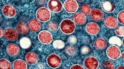Pakistan recorded its first instance of monkeypox, sometimes referred to as mpox, a viral illness, in 2025. On January 24, the patient returned from Dubai. (AFP) Pakistan recorded its first instance of monkeypox, sometimes referred to as mpox, a viral illness, in 2025. On January 24, the patient returned from Dubai. (AFP)