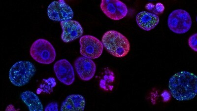 Columbia team uncovers key immune cells for treating relapsed acute Myeloid Leukemia. (Unsplash) Columbia team uncovers key immune cells for treating relapsed acute Myeloid Leukemia. (Unsplash)