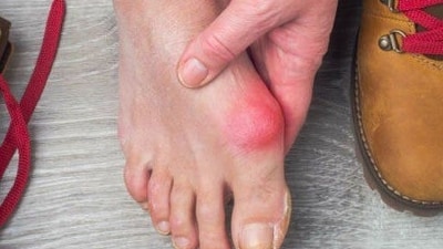 Bunions: A small bump that could ruin your walk. Here’s how to stop it! (File Photo) Bunions: A small bump that could ruin your walk. Here’s how to stop it! (File Photo)