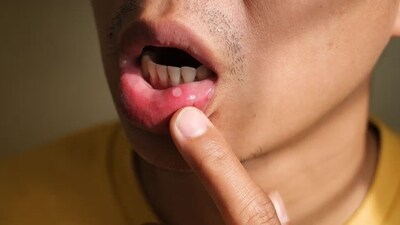 Mouth ulcers may not be dangerous, but they can be inconvenient. (Pinterest) Mouth ulcers may not be dangerous, but they can be inconvenient. (Pinterest)